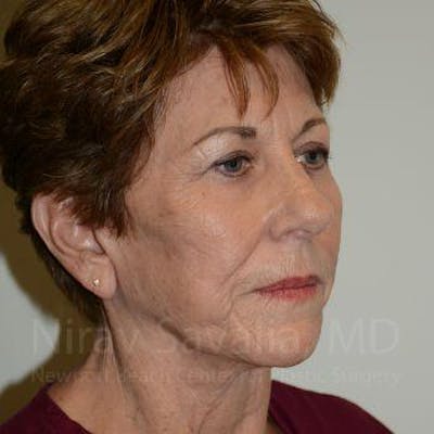 Brow Lift Before & After Gallery - Patient 1655696 - After1