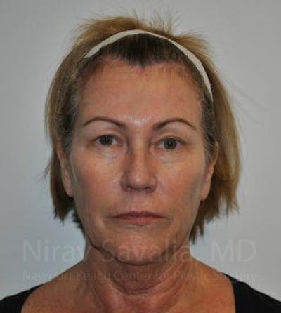 Fat Grafting to Face Before & After Gallery - Patient 1655698