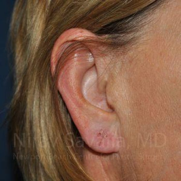 Torn Earlobe Repair Ear Gauge Repair Before & After Gallery - Patient 1655697 - Before1