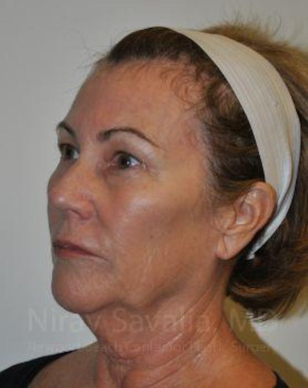 Fat Grafting to Face Before & After Gallery - Patient 1655698 - Before1