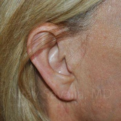 Torn Earlobe Repair Ear Gauge Repair Before & After Gallery - Patient 1655697 - After1
