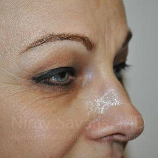 Eyelid Surgery Before & After Gallery - Patient 1655701 - Before1