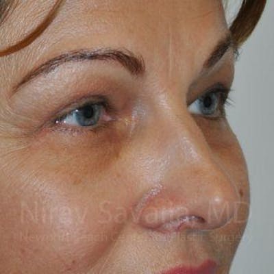 Eyelid Surgery Before & After Gallery - Patient 1655701 - After1