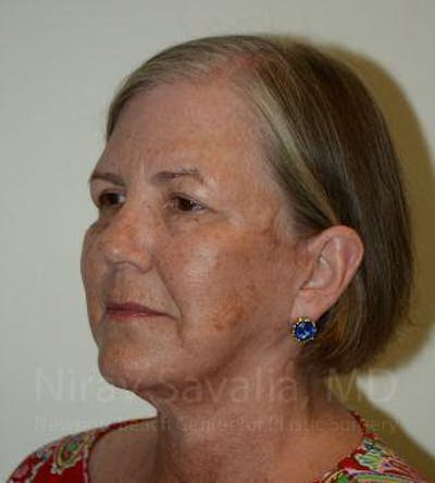 Facelift Before & After Gallery - Patient 1655699 - After1
