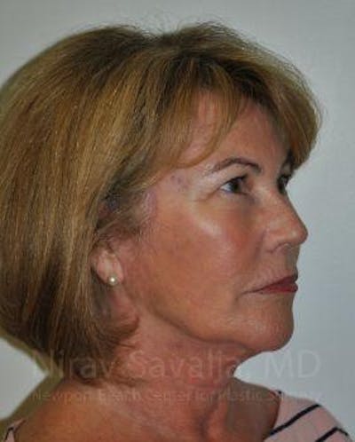 Fat Grafting to Face Before & After Gallery - Patient 1655698 - After1