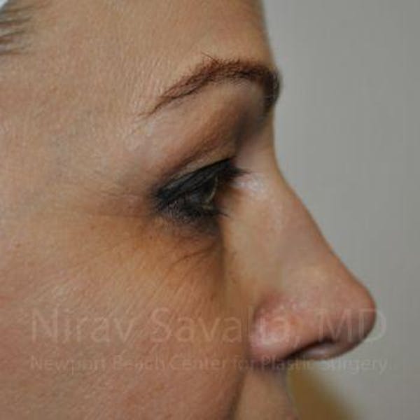 Eyelid Surgery Before & After Gallery - Patient 1655701 - Before1