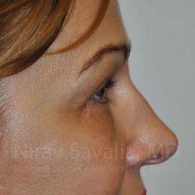Eyelid Surgery Before & After Gallery - Patient 1655701 - After1