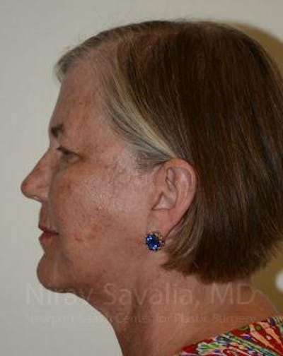 Facelift Before & After Gallery - Patient 1655699 - After1