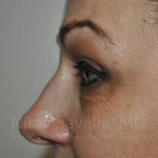 Eyelid Surgery Before & After Gallery - Patient 1655701 - Before1