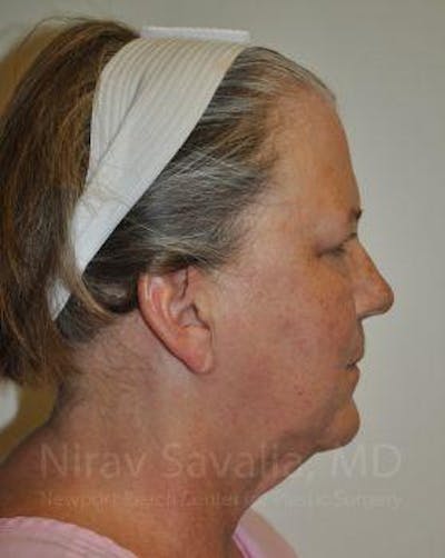 Facelift Before & After Gallery - Patient 1655699 - Before1