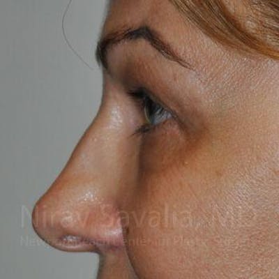 Eyelid Surgery Before & After Gallery - Patient 1655701 - After1
