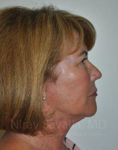 Fat Grafting to Face Before & After Gallery - Patient 1655698 - After1