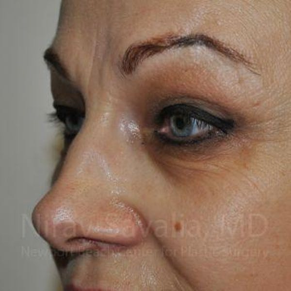Eyelid Surgery Before & After Gallery - Patient 1655701 - Before1