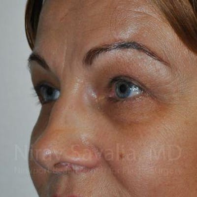 Eyelid Surgery Before & After Gallery - Patient 1655701 - After1