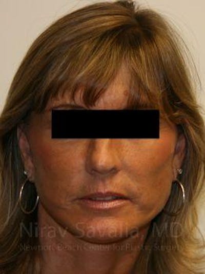 Facelift Before & After Gallery - Patient 1655704 - After1