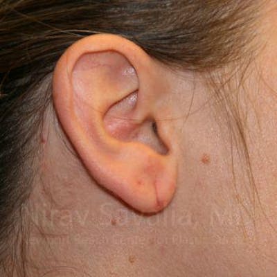 Torn Earlobe Repair Ear Gauge Repair Before & After Gallery - Patient 1655703