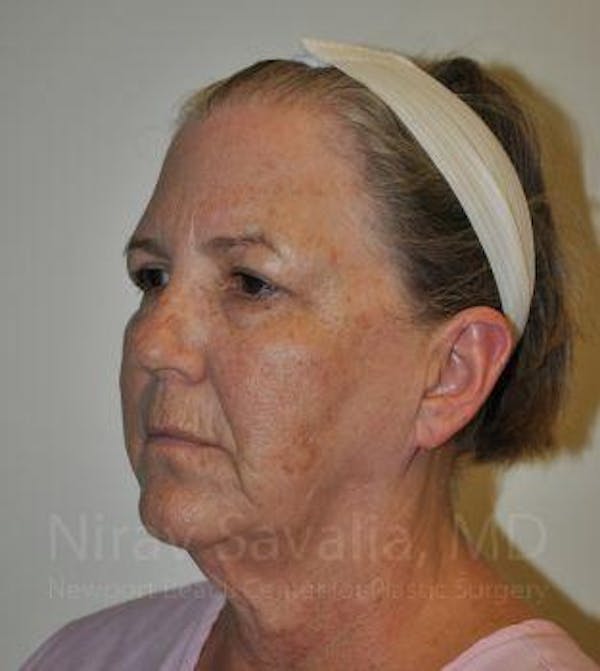 Fat Grafting to Face Before & After Gallery - Patient 1655705 - Before1