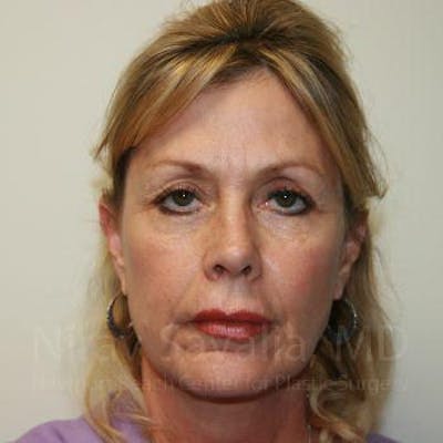 Brow Lift Before & After Gallery - Patient 1655706 - Before1