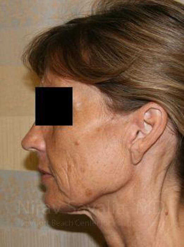 Facelift Before & After Gallery - Patient 1655704 - Before1