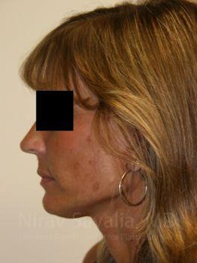 Facelift Before & After Gallery - Patient 1655704 - After1