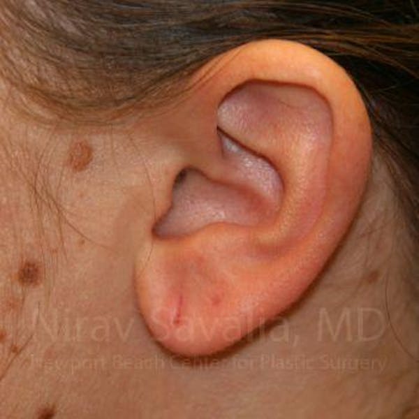 Torn Earlobe Repair Ear Gauge Repair Before & After Gallery - Patient 1655703 - Before1