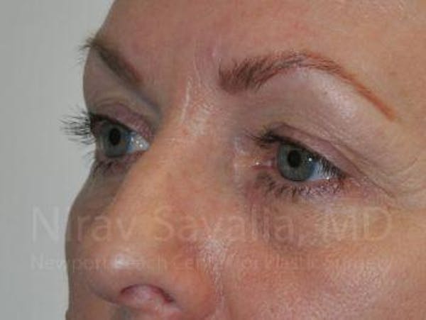 Eyelid Surgery Before & After Gallery - Patient 1655707 - Before1