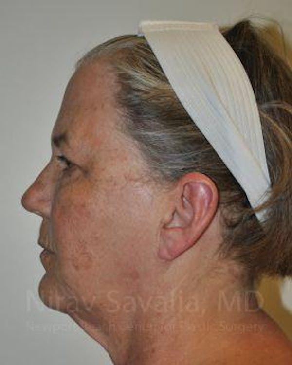 Fat Grafting to Face Before & After Gallery - Patient 1655705 - Before1