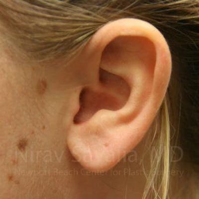 Torn Earlobe Repair Ear Gauge Repair Before & After Gallery - Patient 1655703 - After1