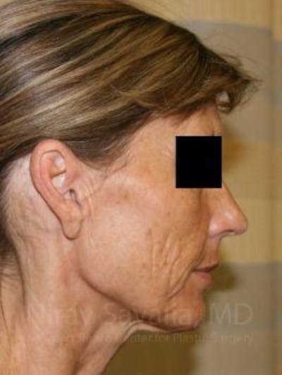 Facelift Before & After Gallery - Patient 1655704 - Before1