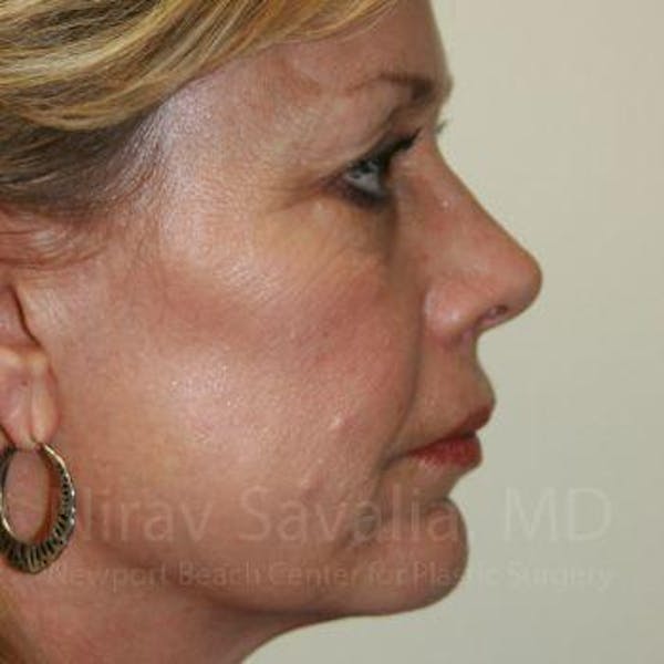Brow Lift Before & After Gallery - Patient 1655706 - Before1