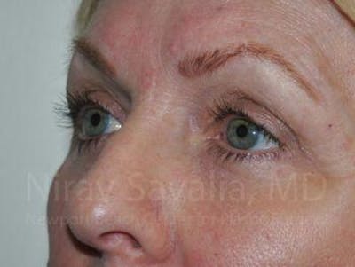 Eyelid Surgery Before & After Gallery - Patient 1655707 - After1