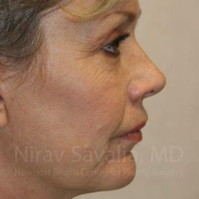 Brow Lift Before & After Gallery - Patient 1655706 - After1