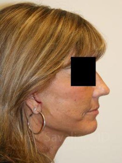 Facelift Before & After Gallery - Patient 1655704 - After1