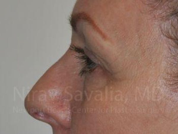 Eyelid Surgery Before & After Gallery - Patient 1655707 - Before1