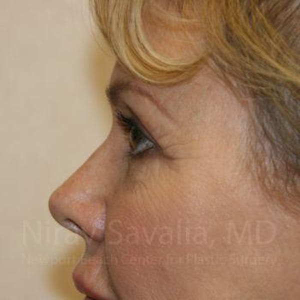 Brow Lift Before & After Gallery - Patient 1655706 - Before1