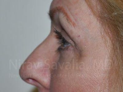 Eyelid Surgery Before & After Gallery - Patient 1655707 - After1