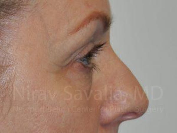 Eyelid Surgery Before & After Gallery - Patient 1655707 - Before1