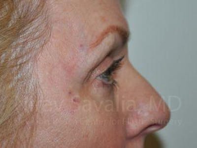Eyelid Surgery Before & After Gallery - Patient 1655707 - After1