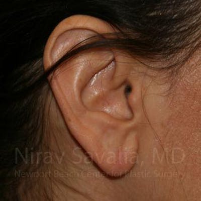 Torn Earlobe Repair Ear Gauge Repair Before & After Gallery - Patient 1655708