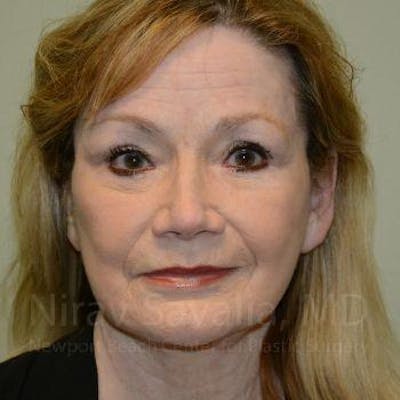 Fat Grafting to Face Before & After Gallery - Patient 1655710