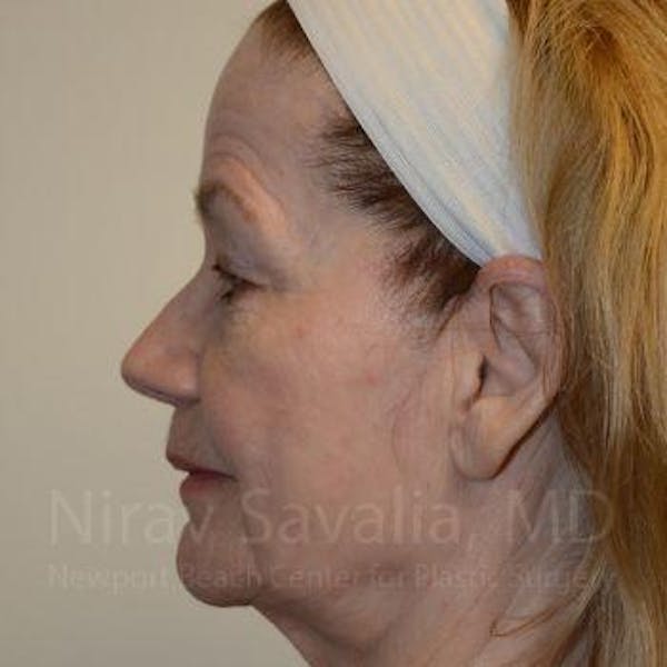 Fat Grafting to Face Before & After Gallery - Patient 1655710 - Before1