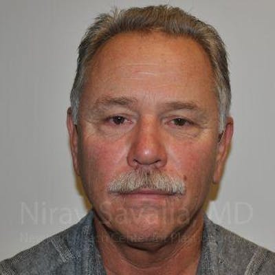 Eyelid Surgery Before & After Gallery - Patient 1655711