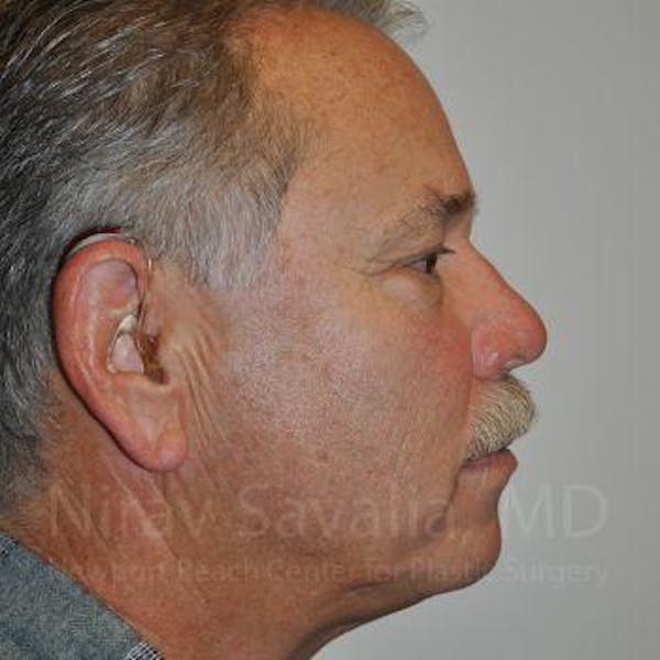 Eyelid Surgery Before & After Gallery - Patient 1655711 - Before1