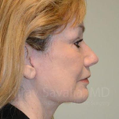 Fat Grafting to Face Before & After Gallery - Patient 1655710 - After1