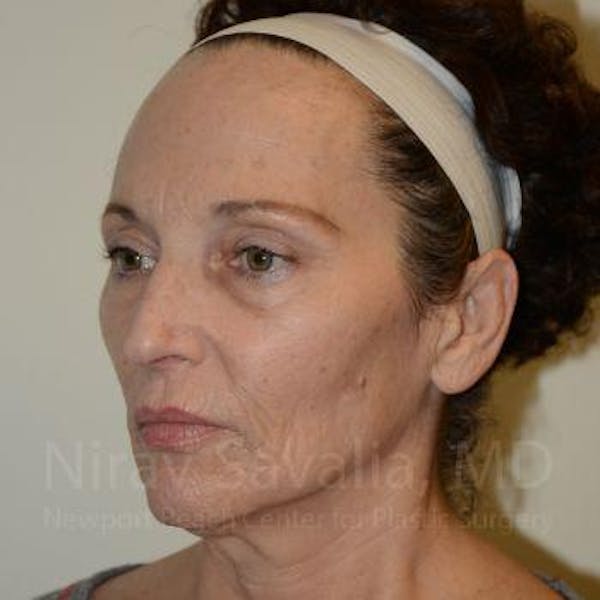 Facelift Before & After Gallery - Patient 1655712 - Before1