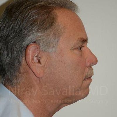 Eyelid Surgery Before & After Gallery - Patient 1655711 - After1