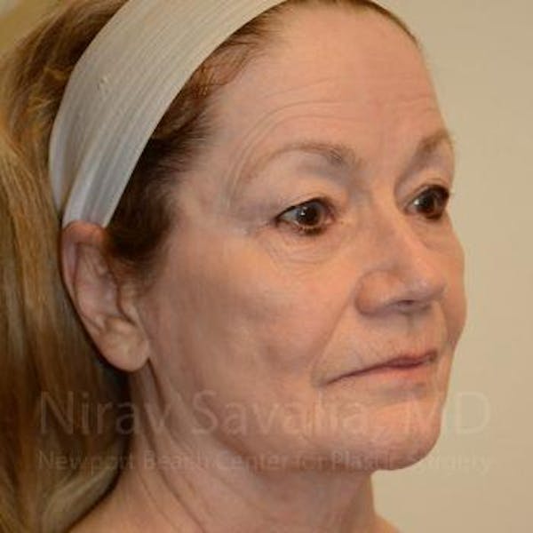 Fat Grafting to Face Before & After Gallery - Patient 1655710 - Before1