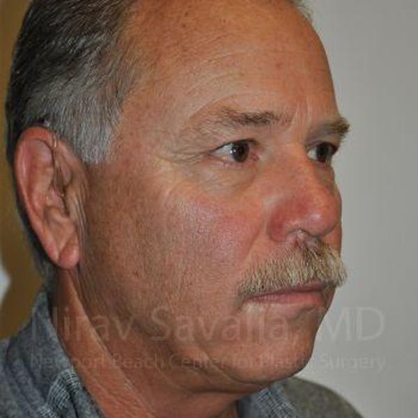 Eyelid Surgery Before & After Gallery - Patient 1655711 - Before1