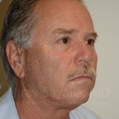 Eyelid Surgery Before & After Gallery - Patient 1655711 - After1