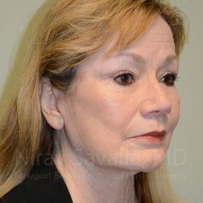 Fat Grafting to Face Before & After Gallery - Patient 1655710 - After1